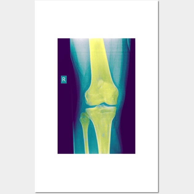 Knee x-ray (C022/3104) Wall Art by SciencePhoto